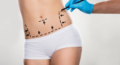 Tummy Tuck (Abdominoplasty) Surgery