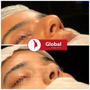 closed-rhinoplasty-01