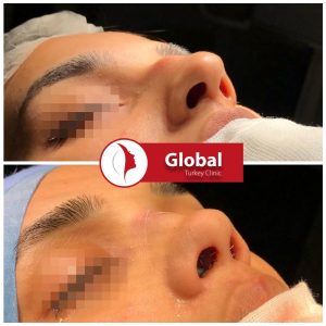 closed-rhinoplasty-02