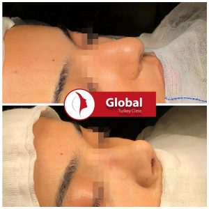 closed-rhinoplasty-04