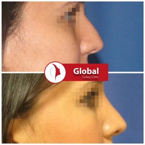 closed-rhinoplasty-06