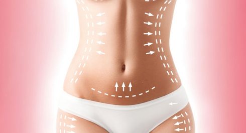 Liposuction