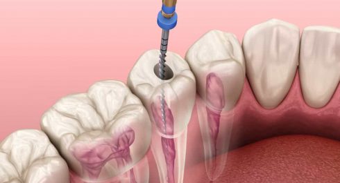 معالجة قناة جذور الأسنان