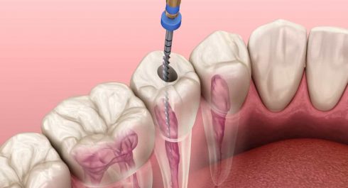 Root Canal Treatment