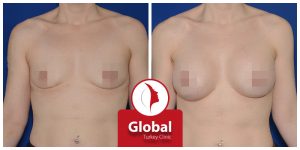 breast-augmentation-01