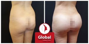 butt-implant-05