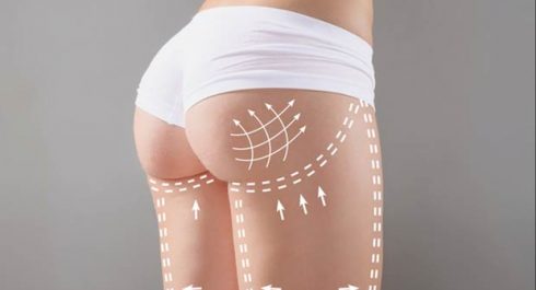 Lipofilling des Fesses