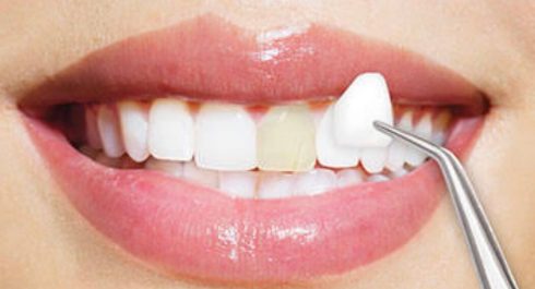 Dental Veneers