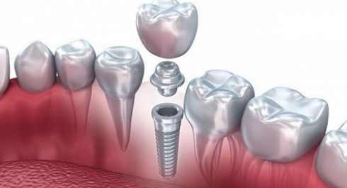 L’implant Dentaire