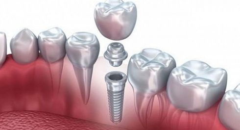 Dental Implant