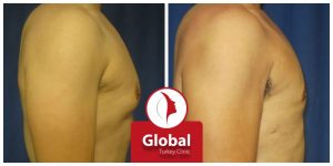 male-breast-reduction-gynecomastia-03