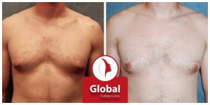 male-breast-reduction-gynecomastia-04