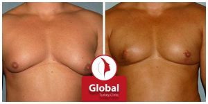 male-breast-reduction-gynecomastia-05