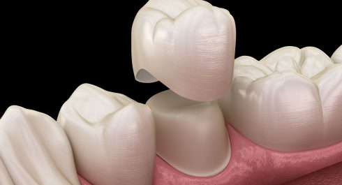 Dental Crowns