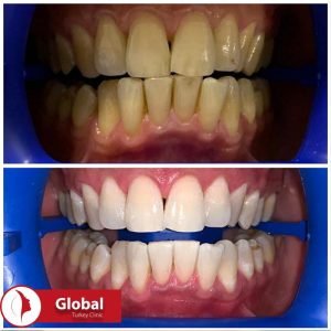 teeth-whitening-01