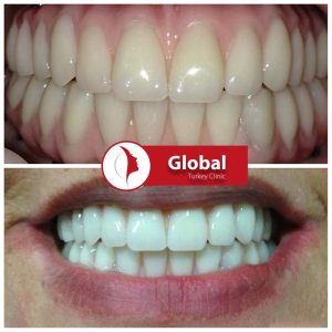 teeth-whitening-04
