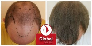 hair-transplant-07